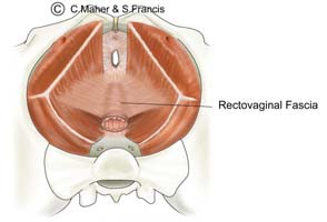 Diagram of a female pelvis indicating the rectovaginal fascia