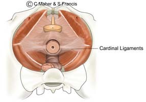 Diagram of a female pelvis indicating the cardinal ligaments